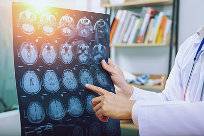 Sacramento brain injury attorney