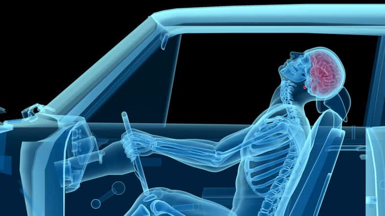 A 3D rendering of what a whiplash looks like while in a car accident.